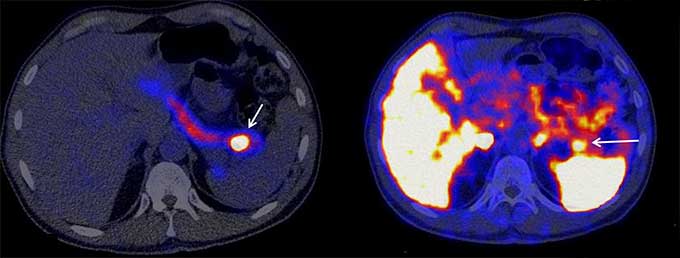 PET scan with and without lizard protein to detect insulinoma